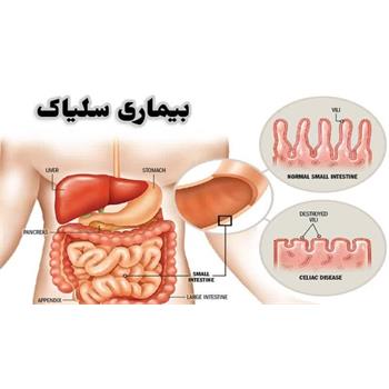 سلیاک